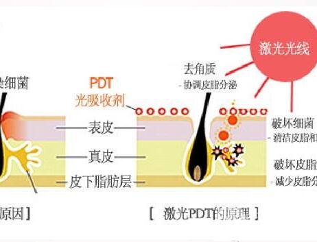 激光缓解痤疮果