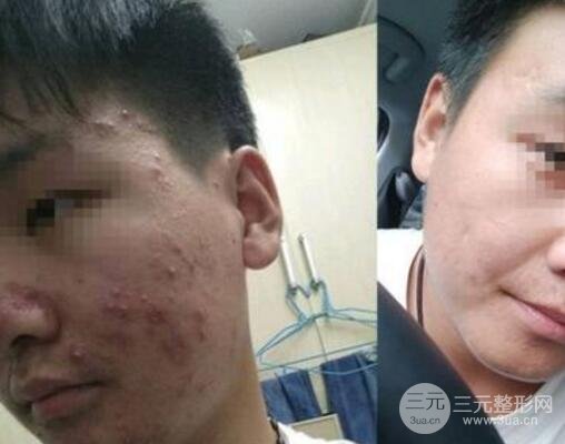 激光缓解痤疮果