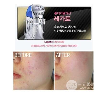 激光缓解痤疮果