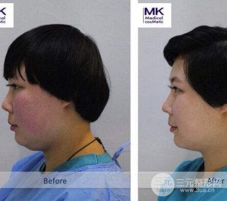 为啥只想隆鼻,医生还让做鼻尖成形术