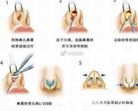 为啥只想隆鼻,医生还让做鼻尖成形术