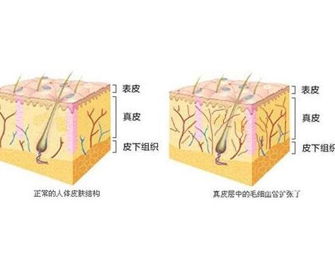 激光去除红血丝