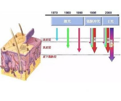 激光去除红血丝
