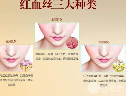 激光去除红血丝