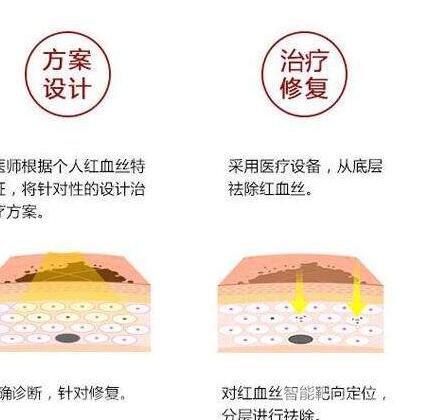 激光去除红血丝