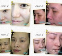 光子嫩肤祛斑的价格贵吗？看了它的功你就明白了！