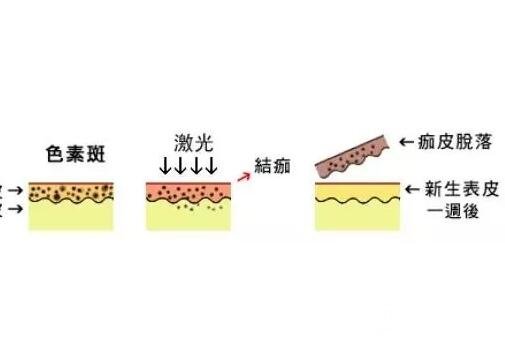 黄褐斑怎么消除