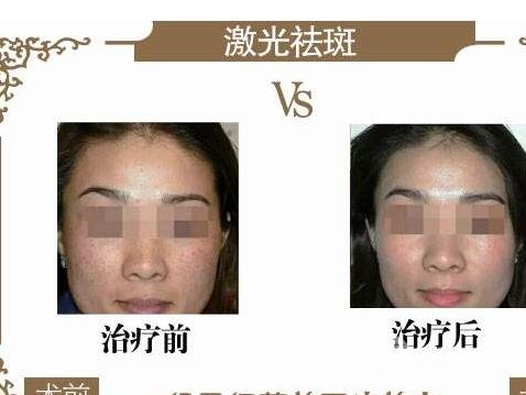 黄褐斑怎么消除