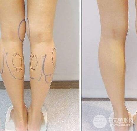 小腿吸脂手术为什么不推荐做