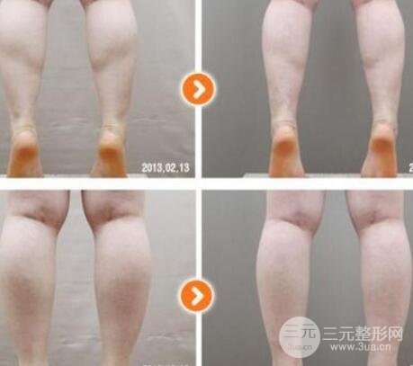 小腿吸脂手术为什么不推荐做