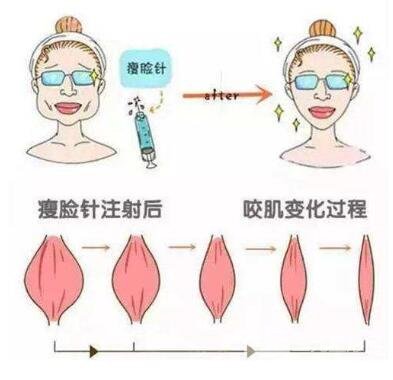 注射瘦脸多长时间见