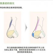 驼峰鼻整形的手术方法讲解，附超全术后护理攻略！