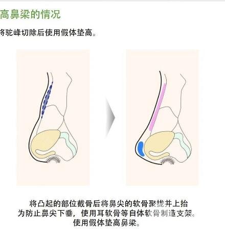 驼峰鼻整形的手术方法