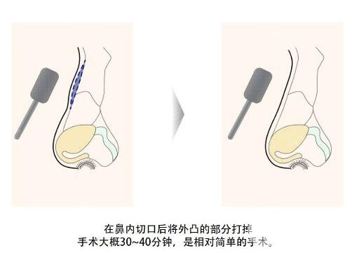 驼峰鼻整形的手术方法