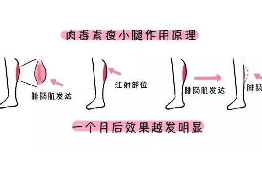 注射瘦腿有用吗