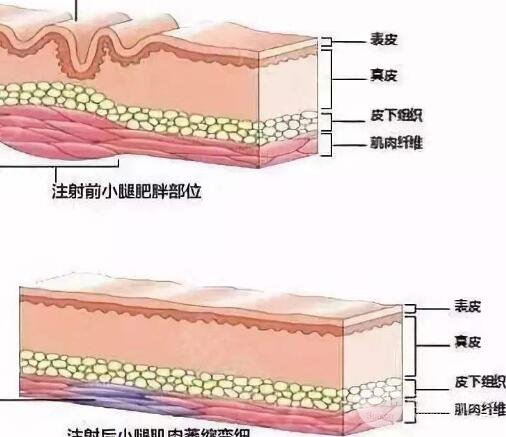 注射瘦腿有用吗