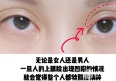 玻尿酸眼窝填充需要几支？用脂肪填充的果怎么样？