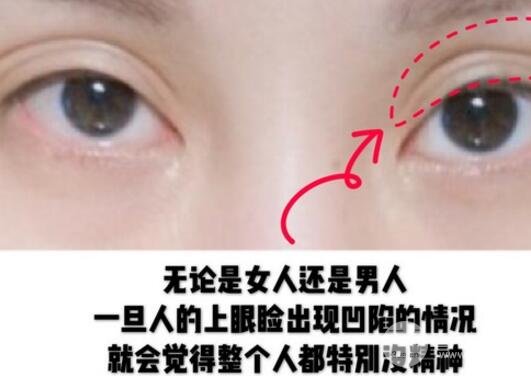 玻尿酸眼窝填充需要几支