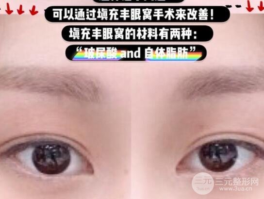 玻尿酸眼窝填充需要几支