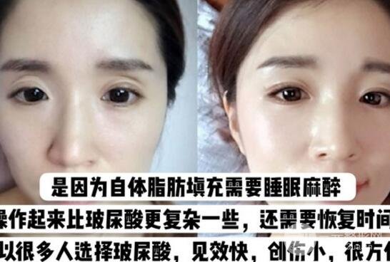 玻尿酸眼窝填充需要几支