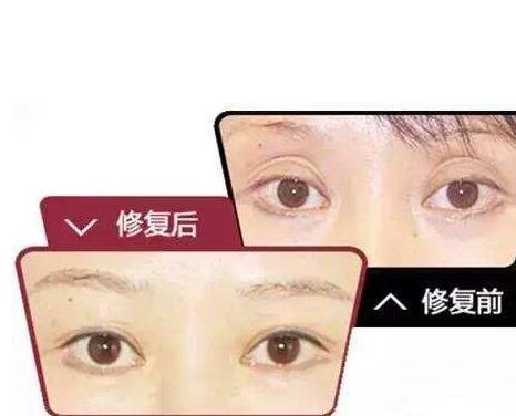 玻尿酸眼窝填充需要几支
