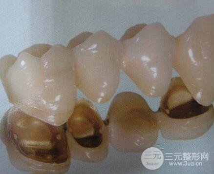 钴铬合金烤瓷牙的优缺点