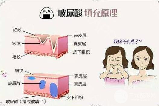玻尿酸去除法令纹