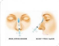 怎么样才能注射隆鼻？有什么优缺点？美鼻小课堂开课啦！