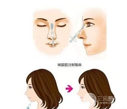 怎么样才能注射隆鼻