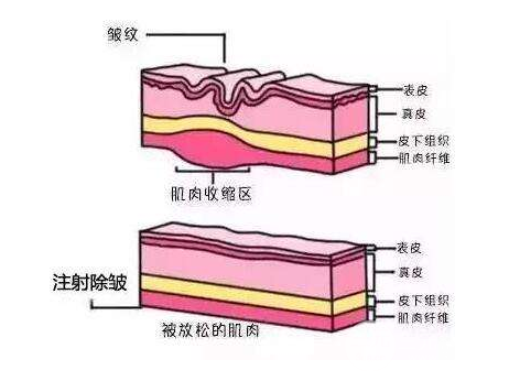 玻尿酸注射除皱怎么样