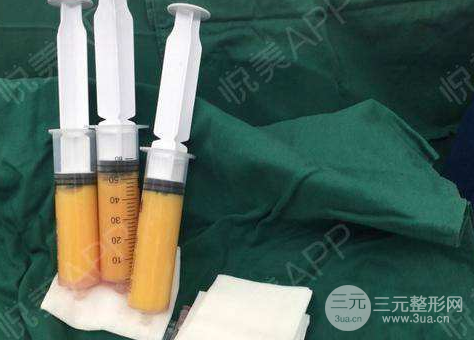 水动力吸脂术后注意事项