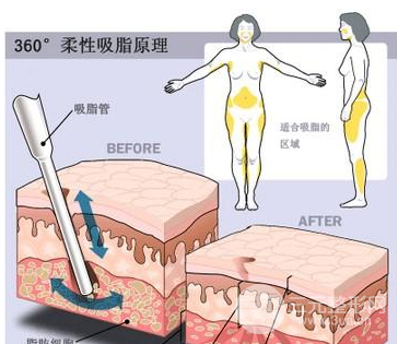 水动力吸脂术后注意事项