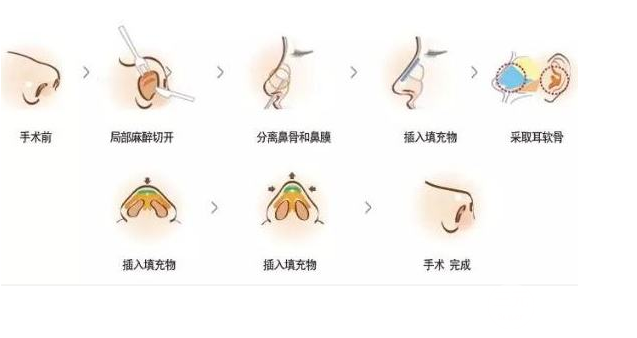 自体软骨移植隆鼻术降低风险吗