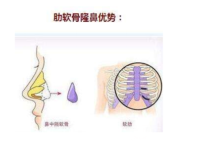 自体软骨移植隆鼻术降低风险吗