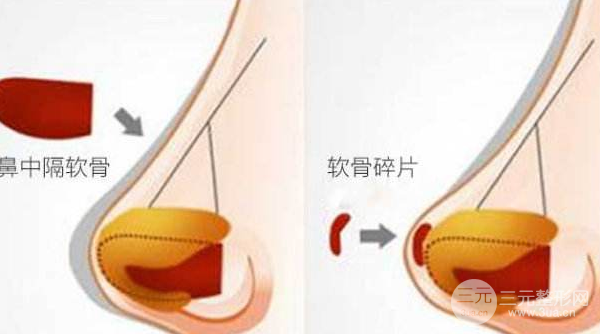 自体软骨移植隆鼻术降低风险吗