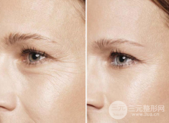 眼角皱纹除皱的方法！医美方式果小胜一筹！