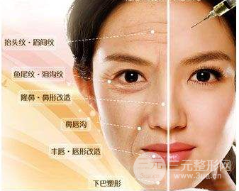 眼角皱纹除皱的方法