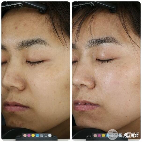 丝丽动能素注射果图