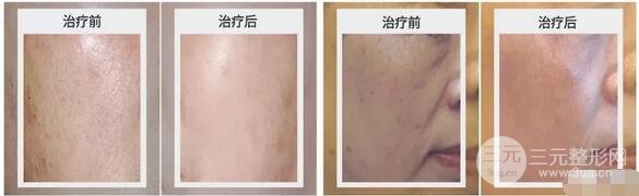 注射除皱果图