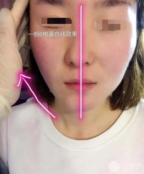 埋线除皱面部轮廓不紧致、肉脸