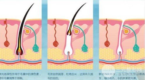 激光脱毛还会再长吗
