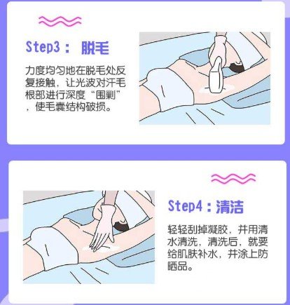 激光脱毛还会再长吗