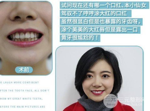 全瓷牙贴面能撑多久