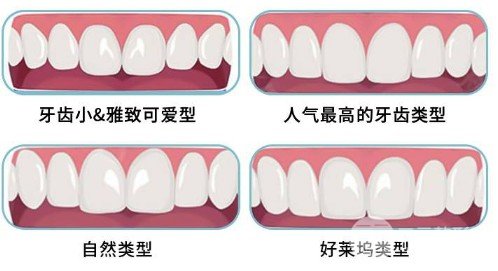 全瓷牙贴面能撑多久