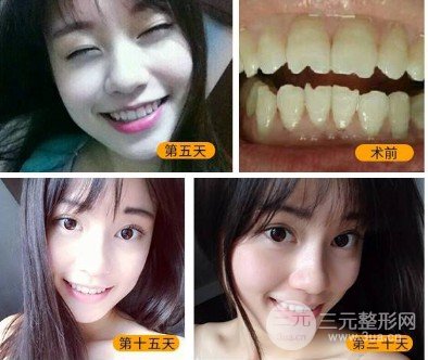 全瓷牙贴面能撑多久