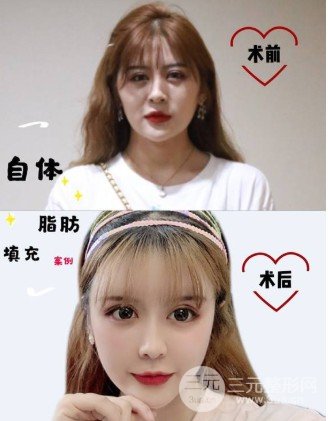 脂肪转移术