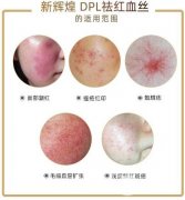激光去红血丝果怎么样?缓解原理及注意事项 激光去红血丝果怎么样?缓解原理及注意事项