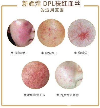激光去红血丝果怎么样