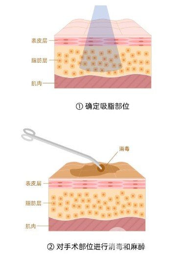 吸脂去眼袋成好吗