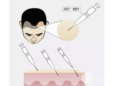 连锁植发机构有哪些